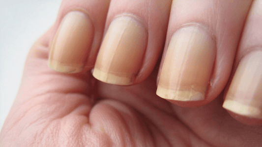 Mains avec des ongles jaunis